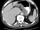CT scan gastric CD.jpg