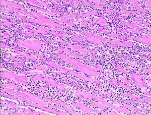 Myocardial infarct emmolition phase histopathology