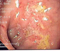 CD serpiginous ulcer