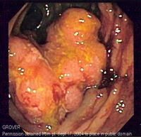 Colorectal cancer endo 2