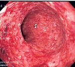 CD colitis 2