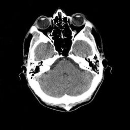 Head CT scan