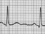 Electrocardiogram