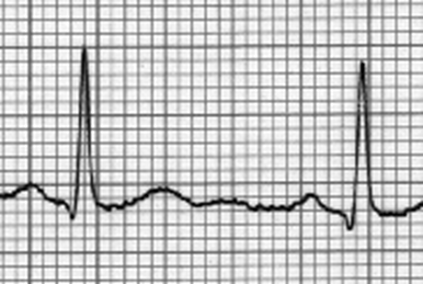 Electrocardiography - Wikipedia