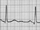 Electrocardiogram