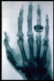 Roentgen-x-ray-von-kollikers-hand