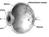 Glaucoma