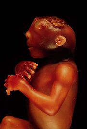 Anencephaly side