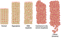 Cancer progression from NIH