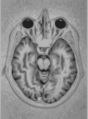 Brain Mri nevit