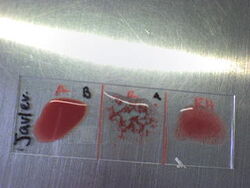 Blood type - Wikipedia