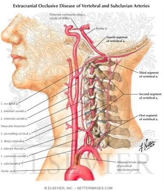 Spine Back Arteries Vertebral Artery Ranzcrpart1 Wiki Fandom