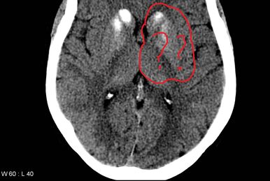 Regions anterior:Anatomical snuff box:Boundaries, RANZCRPart1 Wiki