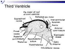 Third ventricle & boundaries | RANZCRPart1 Wiki | Fandom