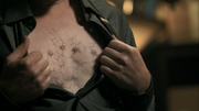 1x07 Druitt Electroshock marks