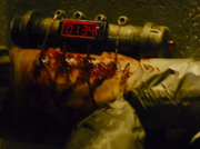The pipe bomb in Diegos arm.