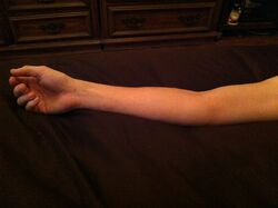 Gestreckter Arm