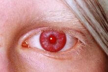 Rotes Auge