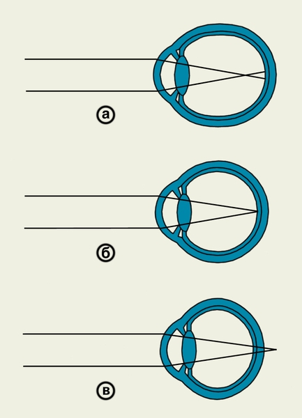 Схема рефракции нормального глаза