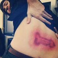Anthony's rash