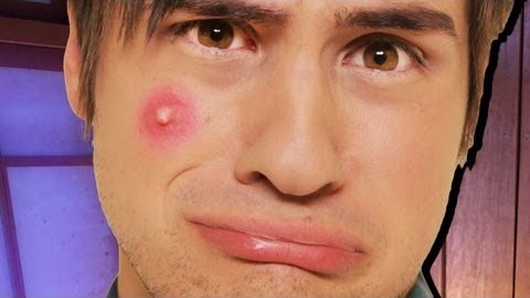 Biggest Zit Ever Smosh Wiki Fandom