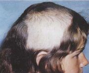 Trichotillomania1-300x245