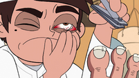 S2E4 Marco gets toenail lodged in his eye socket