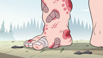 S2E10 King Butterfly's blistered right foot