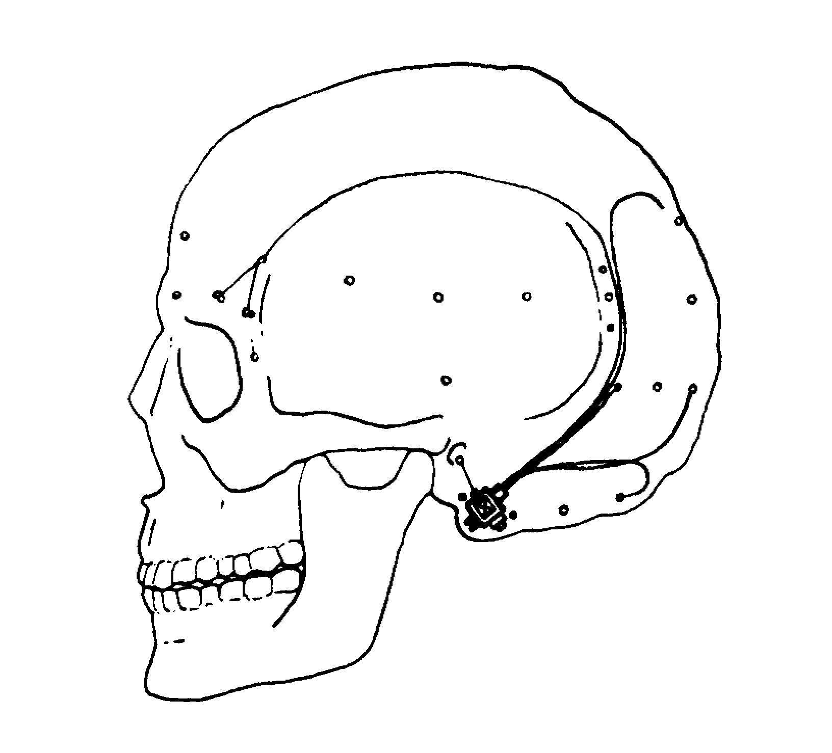 Implant communicator appearance 
