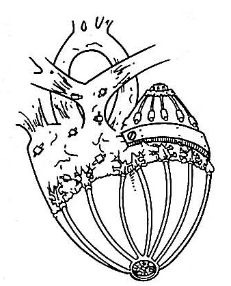 Q-2 artificial heart appearance 
