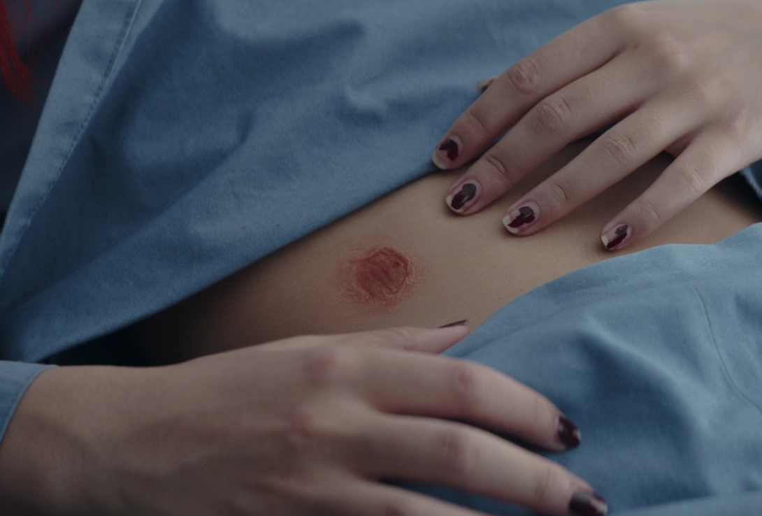 A bacta-treated lightsaber penetration wound on human skin