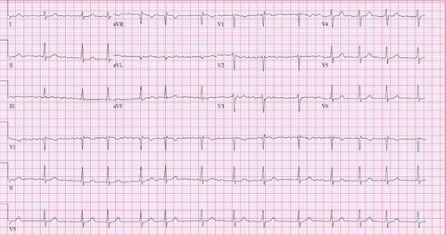 FA EKG