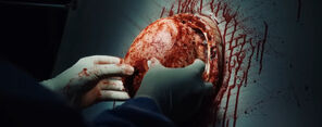 Brain surgery