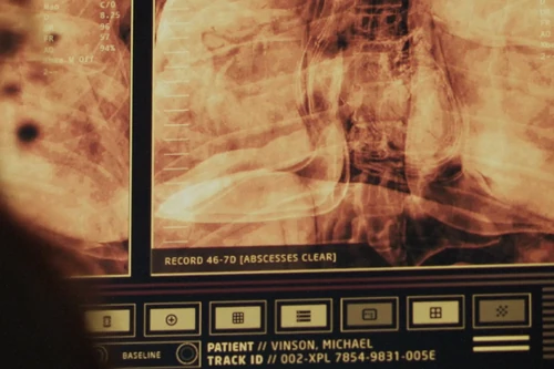 Vinson's X-ray
