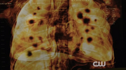 508 Hythylodium lung sickness