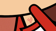 Lynn's popped out vein.
