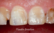 Erosion-dental