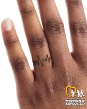Reconstruction of right ring-finger tattoo