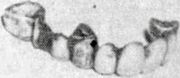 MCJD dental bridge