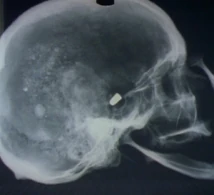X-ray of victim's skull
