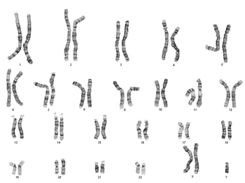 klinefelter syndrome karyotype