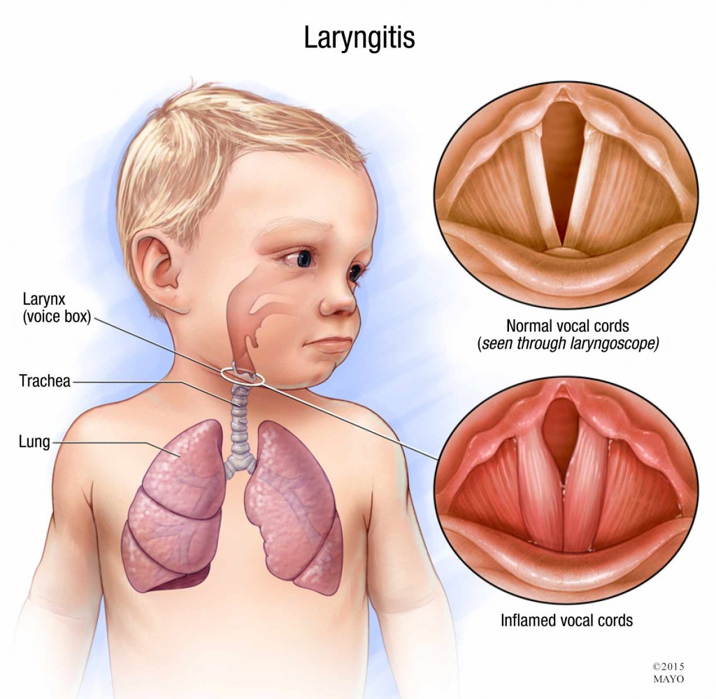 laryngitis-diseases-and-their-cures-wikia-fandom