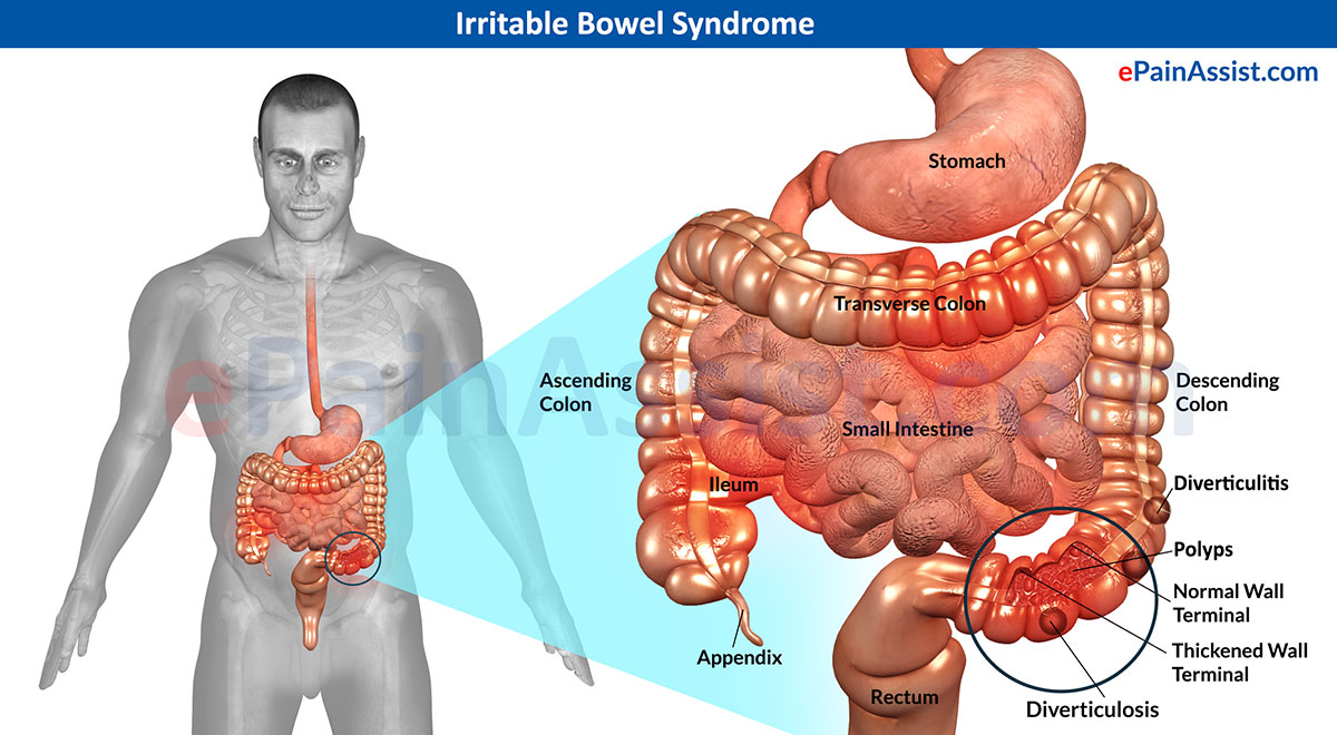 irritable bowel syndrome diagram