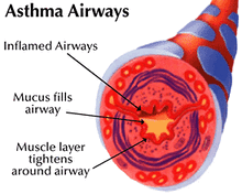 AsthmaAirways