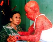 Agent-Orange-dioxin-skin-damage-Vietnam