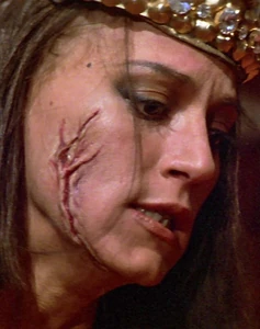 Gedren's scar