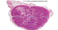 Ganglion lymphatique