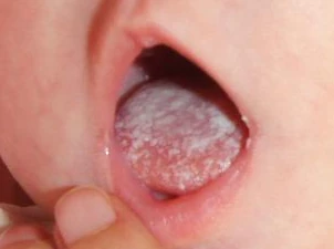 Muguet Buccal Wikige Wiki Fandom