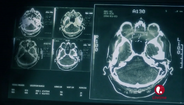Witchesmri