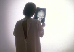 Scully radiographie Journal de Mort cancer